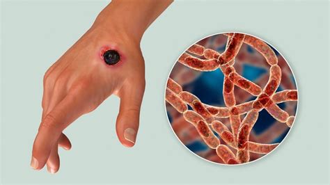 What is Anthrax?