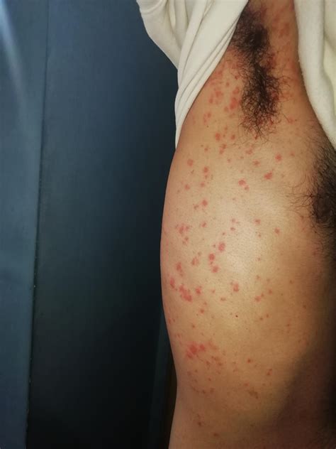 Is this scabies? I got scabies 2 months ago and treated it with sulfure