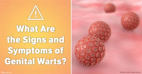 What Are the Signs and Symptoms of Genital Warts?