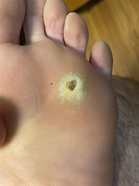 If the immune system needs time to detect warts, can’t we speed up the