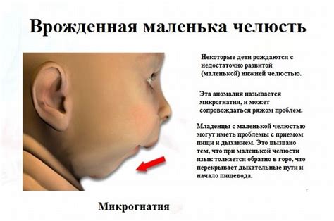 Микрогнатия (недоразвитая маленькая нижняя и верхняя челюсть): симптомы ...