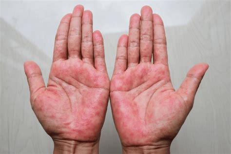 1,501 Contact Dermatitis Hand Royalty-Free Photos and Stock Images ...