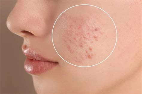 Penyebab Jerawat dan Cara Penanganannya - serikatnews.com