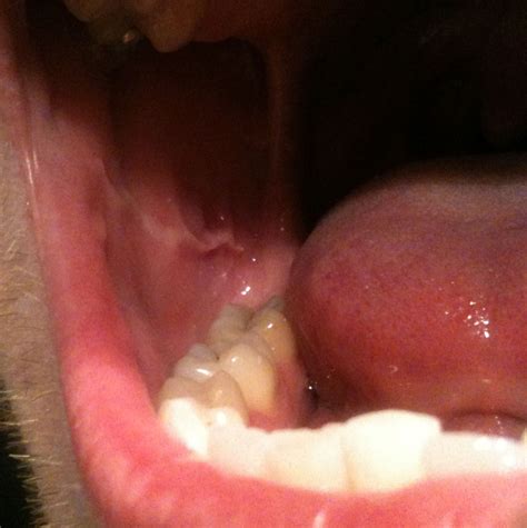 Morsicatio Buccarum Temporalis