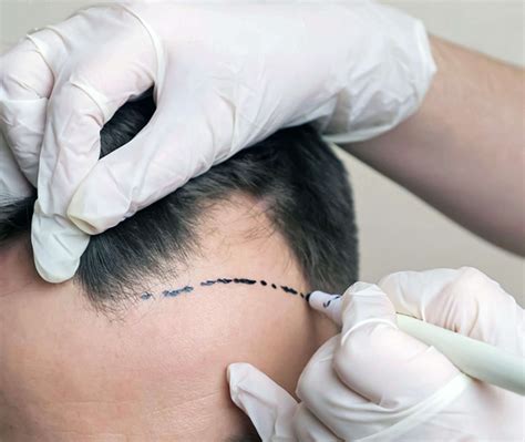 non surgical hair replacement 14