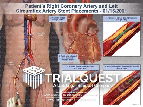 Right Coronary Artery and Left Circumflex Artery Stent Placements...