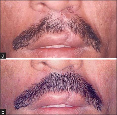 Cleft lip scar treatment through hair transplant in Lahore Pakistan |Call now