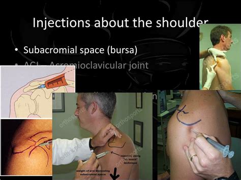 PPT - Injections about the shoulder PowerPoint Presentation, free ...