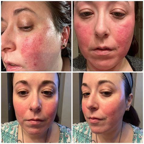 1202 best r/rosacea images on Pholder | Went out last night without any