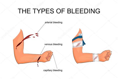 types  bleeding stock vector artemida psy