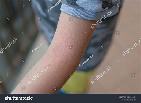 Little Child Arm Atopic Dermatitis Rash Stock Photo 2162769781 ...