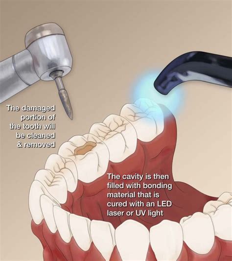 Decay Tooth Filling