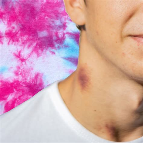 Hickey