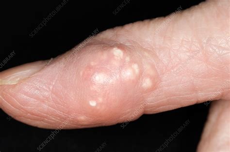 Tophus
