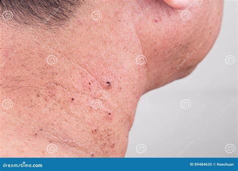 Mole Removed Via Skin Graft Procedure Leaving Scar Stock Image - Image of nevus, asian: 89484635