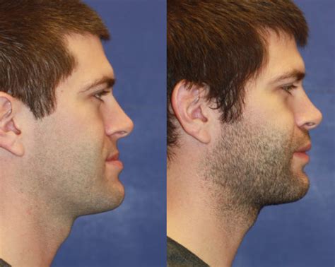 orthognathic surgery board certified plastic surgeons  florida