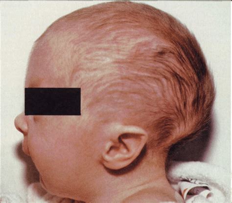 An infant with low-set ears and developmental delay | medtigo