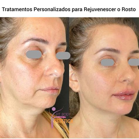 Como Rejuvenescer O Rosto - Tratamentos Personalizados para Rejuvenescer o Rosto - Clínica Fit Body ...