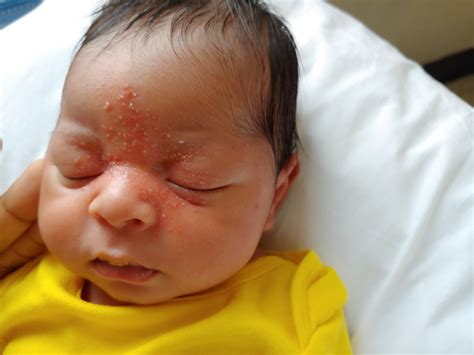 Newborn Rashes And Skin Conditions