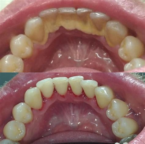 full mouth debridement artofit