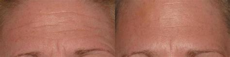 Botox Case 2 Before and After Photos Milwaukee