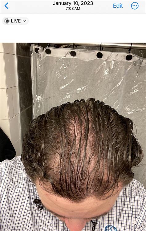 does finasteride regrow hair 5