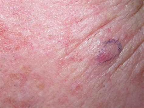 Merkel Cell Cancer Images - Merkel Cell Carcinoma - Merkel cell ...