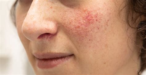 ¿Qué es la rosácea? Causas y tratamientos - The Facial Concept