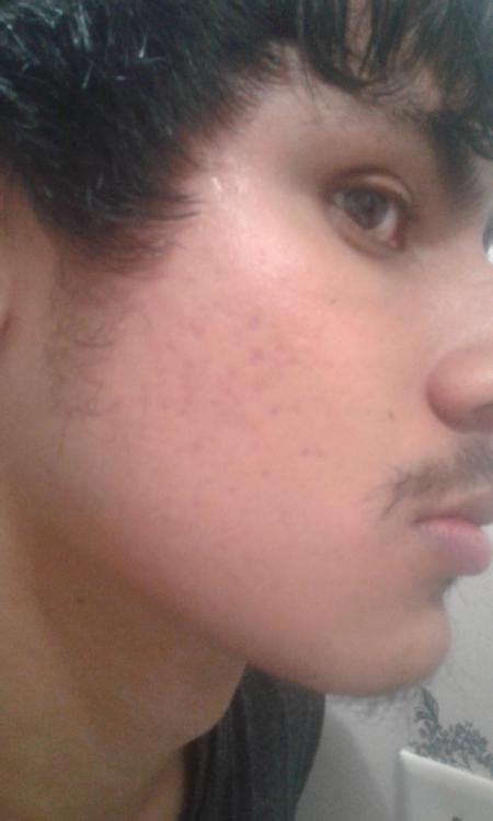 Pitted Acne Scars. – Scar treatments – Acne.org Forum