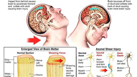 Diffuse axonal injury - Injury Choices