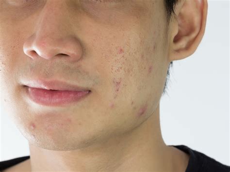 skin bumps    pimples  arent
