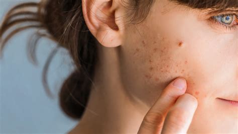 How To Get Rid Of Acne Under The Skin