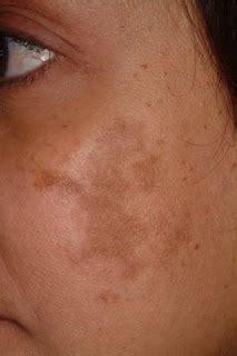 chloasma treatment - pictures, photos