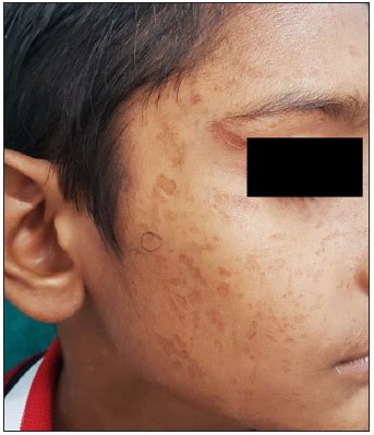 Dermatological disorders with varioliform scars: A clinical approach ...