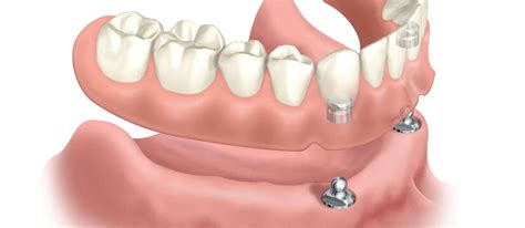 Pros and Cons of Snap-In Dentures | Rockville Dental Arts