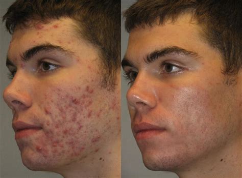 Acne Treatment Transformation