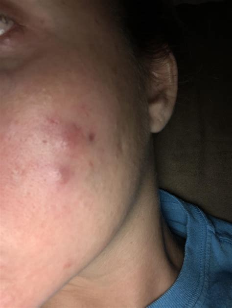 Painful Cysts!! The top cyst is a recurring one it’s so painful & the