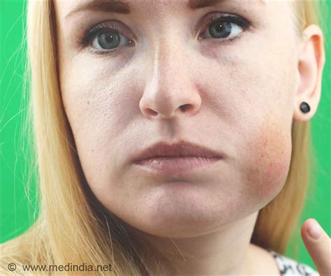 Facial Edema Pictures – Telegraph