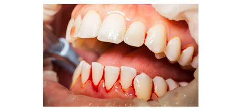 Dente Furado Sangrando O Que Fazer - Gengiva Sangrando - Clarice Vieira Odontologia