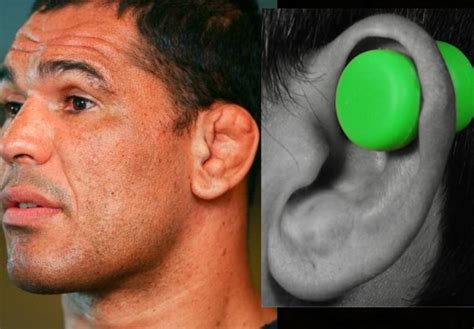 Cauliflower Ear Before And After