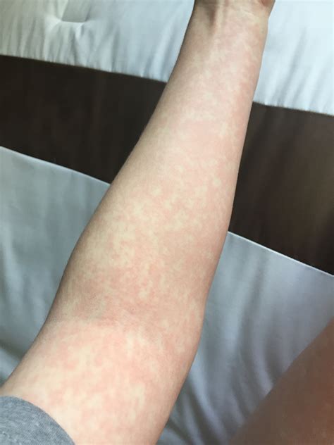 Lamictal Rash Vs. SJS: How To Tell The Difference (with Pictures) 2