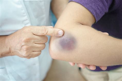 bruises   body heres   means