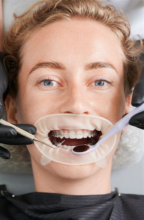 What Dental Insurance Covers Braces? - Best Dental