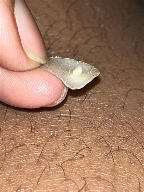 Pimple patch that I left on for 2 days : r/popping