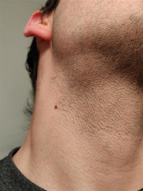 lump  jaw  dental injection  jamie gibb blog