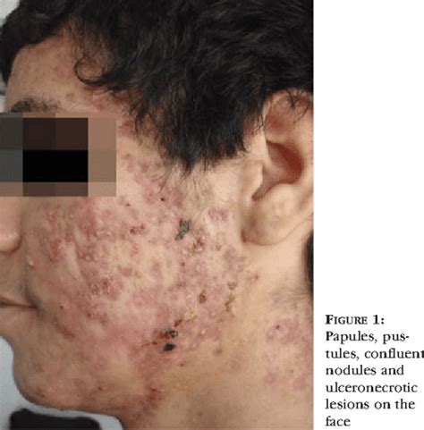 [PDF] Disabling Acne Fulminans * Acne fulminans incapacitante | Semantic Scholar