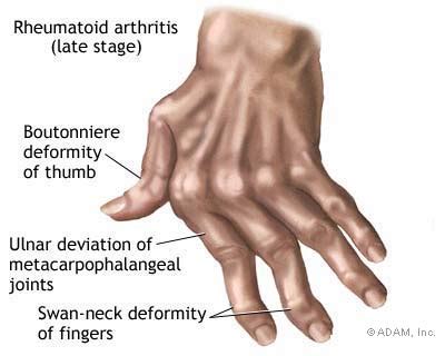 hand deformities