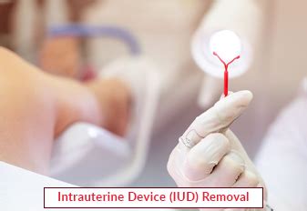 IUD Removal Services | Intrauterine Device (IUD) Removal | EdhaCare