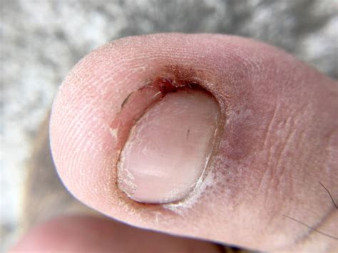 270+ Curved Toenails Stock Photos, Pictures & Royalty-Free Images - iStock