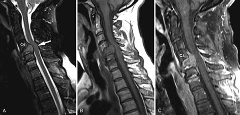 Cervical Stenosis Mri - img-Abhilasha